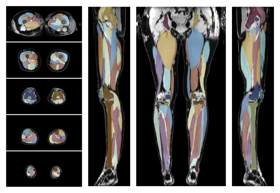 Overlay of automated muscle segmentation labels on dixon water image.